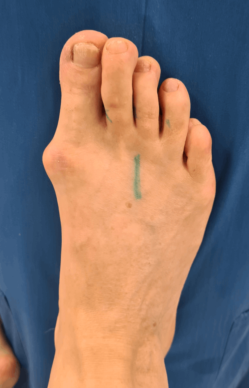 Как избавиться от косточки на ноге у большого пальца