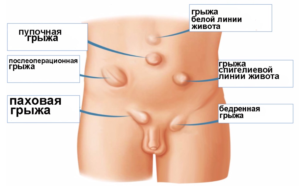 Паховая грыжа: причины, симптомы и хирургическое лечение в Москве в ФНКЦ ФМБА
