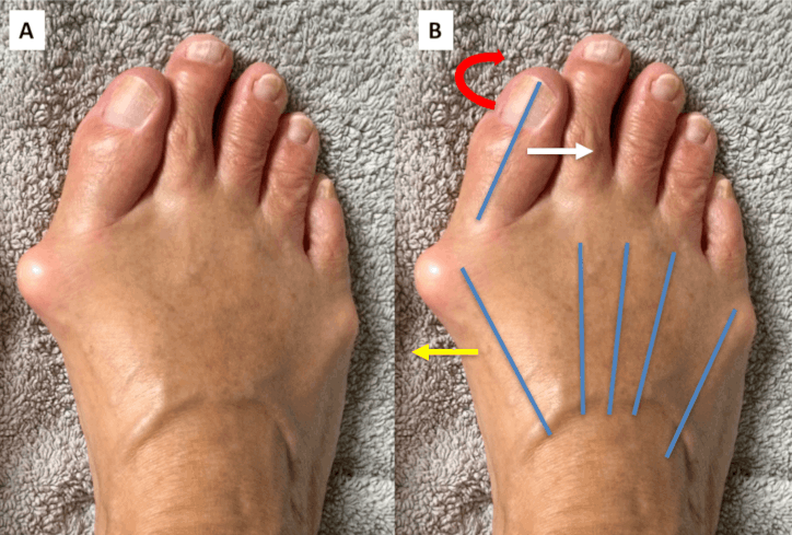 Вальгусная деформация или «косточка» большого пальца ноги