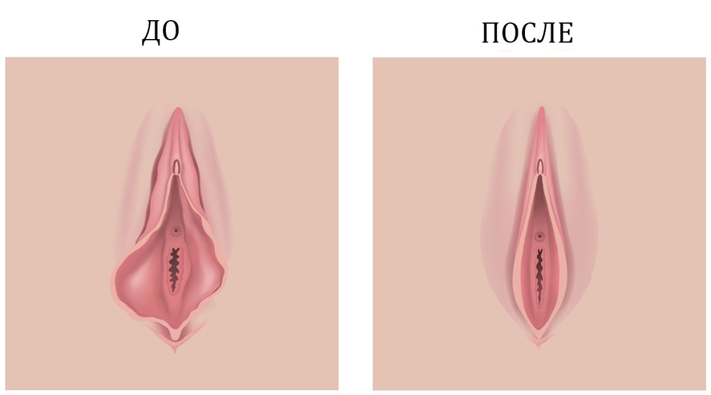 Большие половые губы
