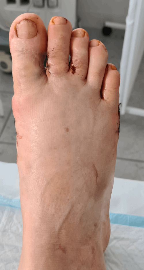 Зуд между пальцами ног: причины и как от него избавиться?